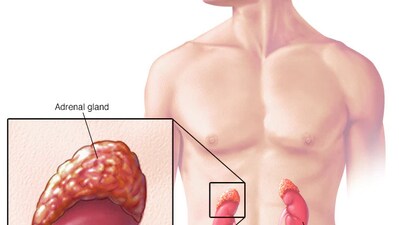 Adrenocortical Carcinoma section - the Cushing’s Syndrome Learning Zone