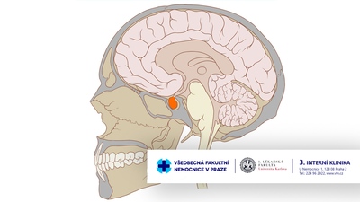 Problematika adenomů hypofýzy a jiných selárních lézí